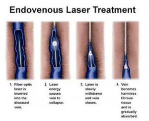 Proses penyembuhan varises menggunakan teknologi Endovenous Laser Ablation Treatment (Sumber: nazveincenter.com)